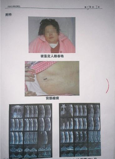 高位瘫痪的赖春燕及其鉴定所需的光学照片。图片由患者家属提供